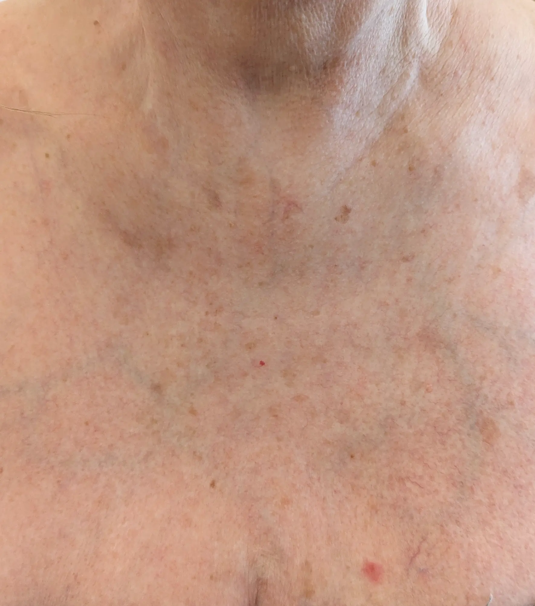 Zaffiro — Neck, Chest — po