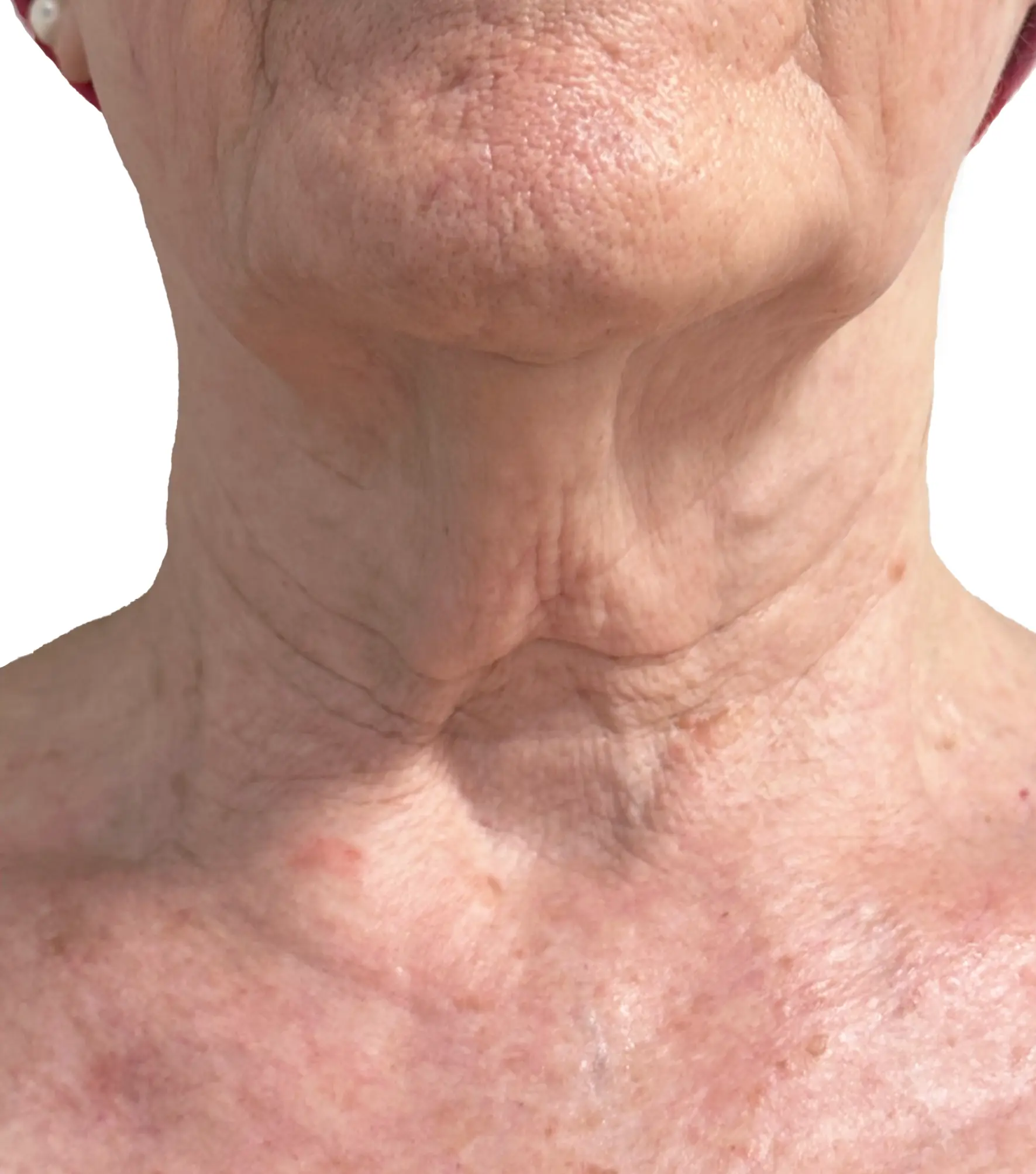 Zaffiro — Neck, Sagging — po