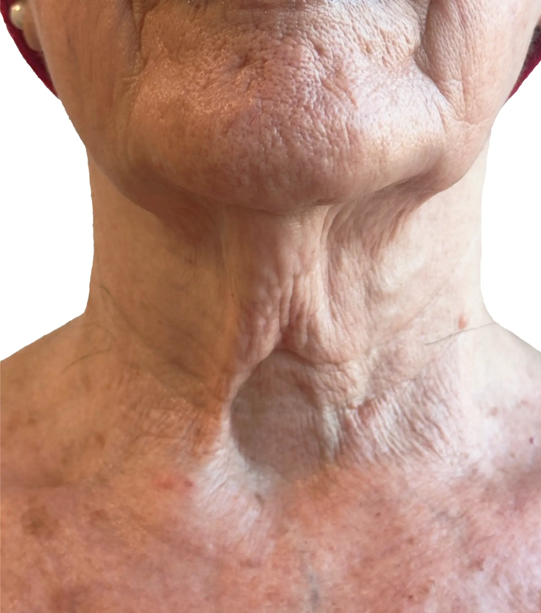 Zaffiro — Neck, Sagging — przed