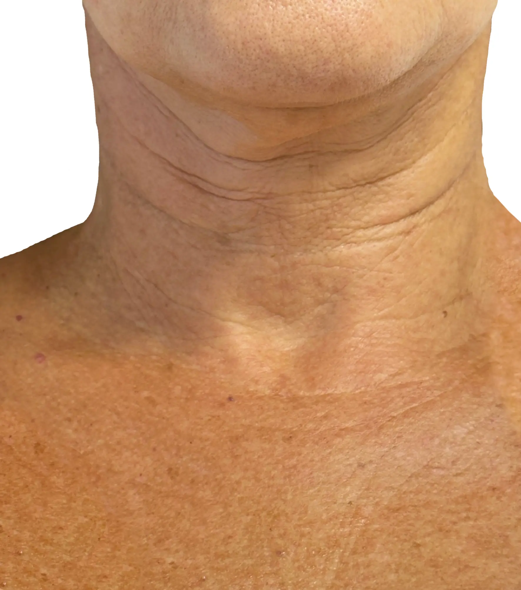 Zaffiro — Neck, Sagging — po