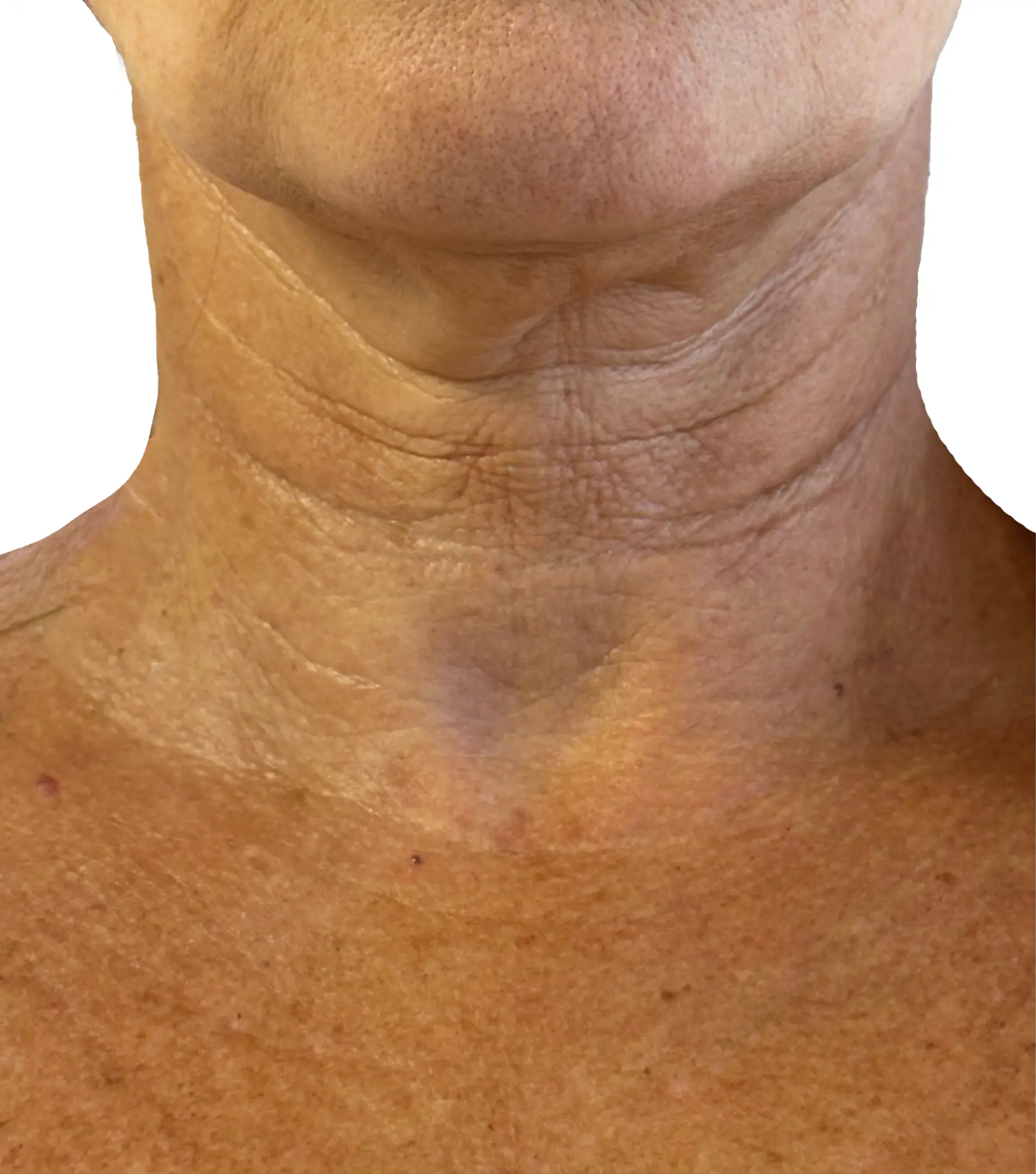 Zaffiro — Neck, Sagging — przed