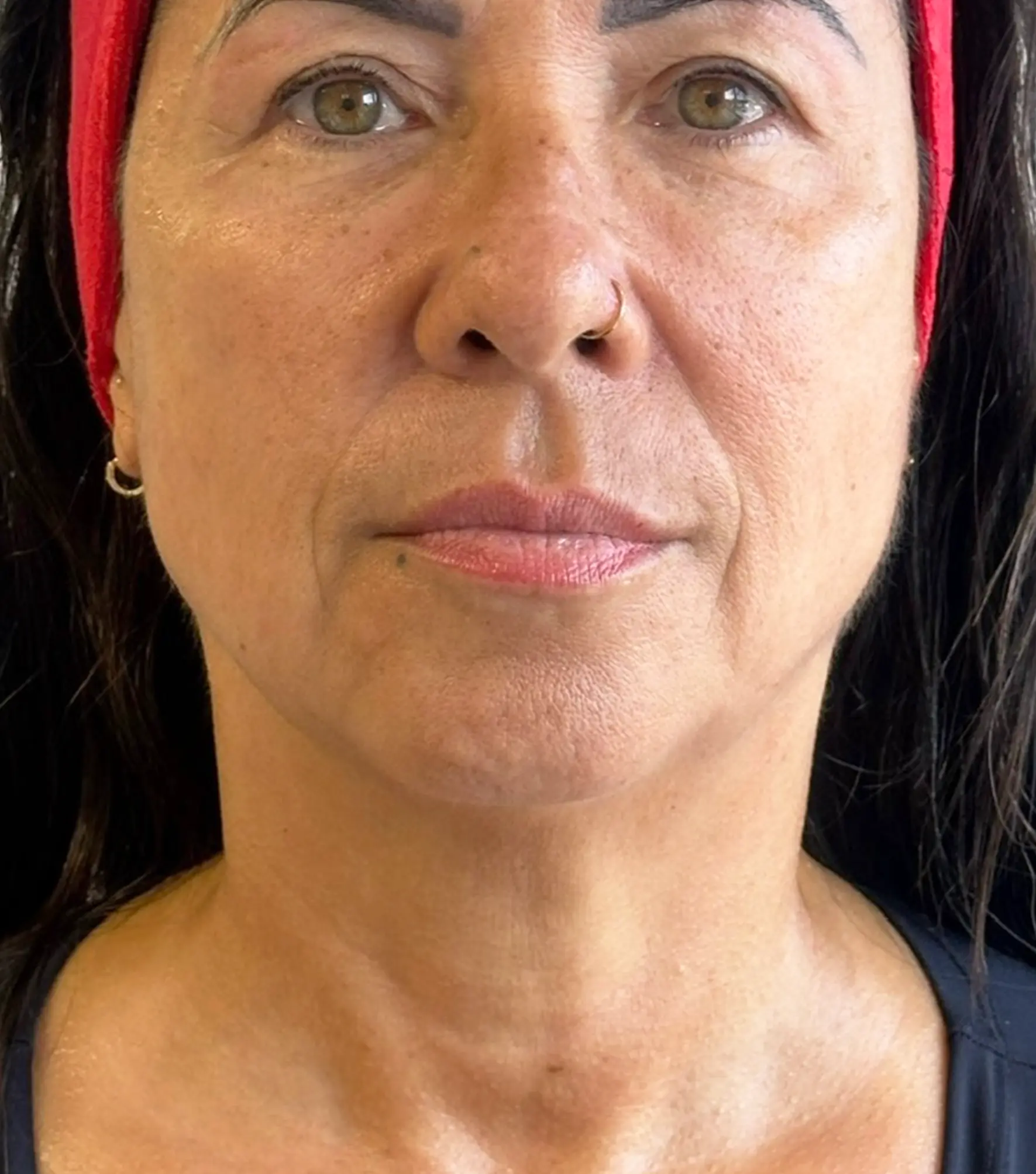 Zaffiro — Face and neck, Tissue flaccidity — po