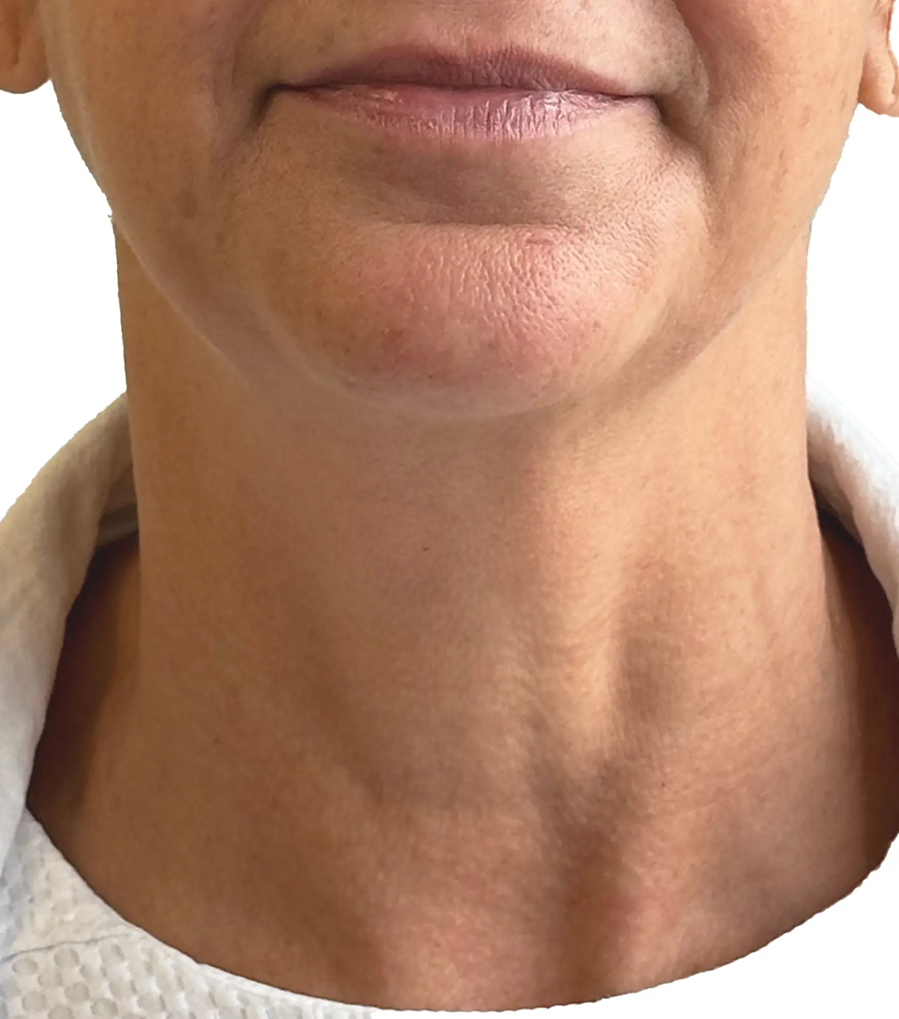 Zaffiro — Neck, Sagging — po